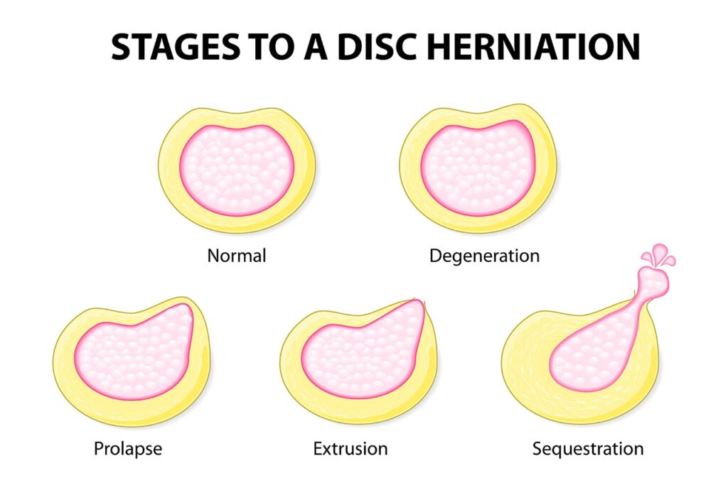 Best physiotherapist for disc bulge near Pari Chowk
